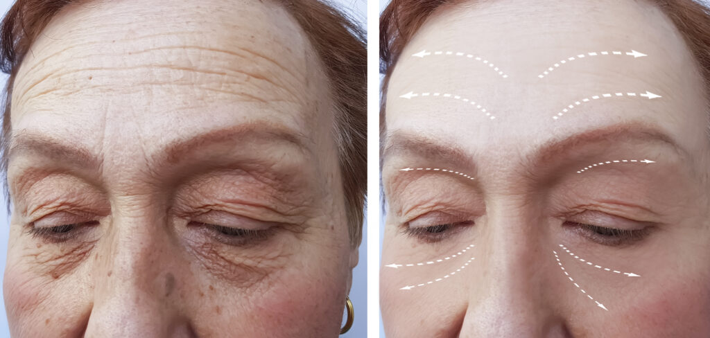 Toksyna botulinowa (Botox)

Zastosowanie:

    Zmarszczki poprzeczne czoła

    Kurze łapki (zmarszczki wokół oczu)

Działanie: Botox blokuje przewodnictwo nerwowo-mięśniowe, co powoduje czasowe „rozluźnienie” mięśni mimicznych, odpowiedzialnych za tworzenie zmarszczek.

Efekt: Widoczny po 3–7 dniach, utrzymuje się ok. 3–6 miesięcy.